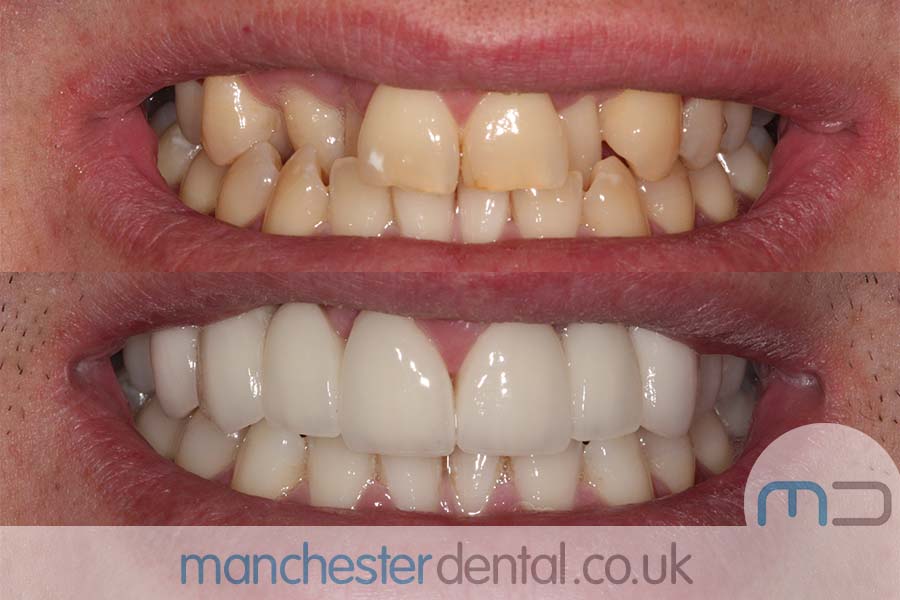 crowns and veneers in manchester