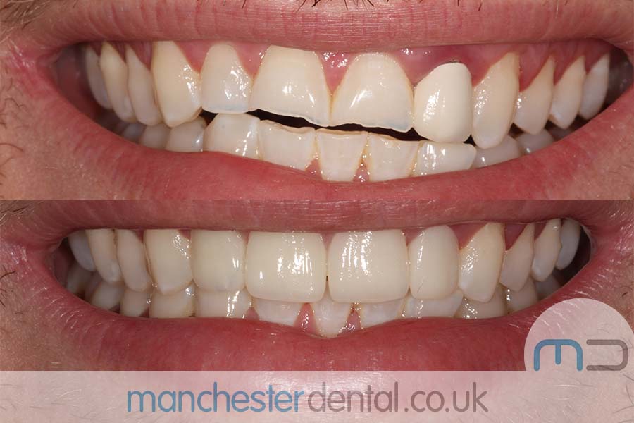 crowns and veneers in manchester