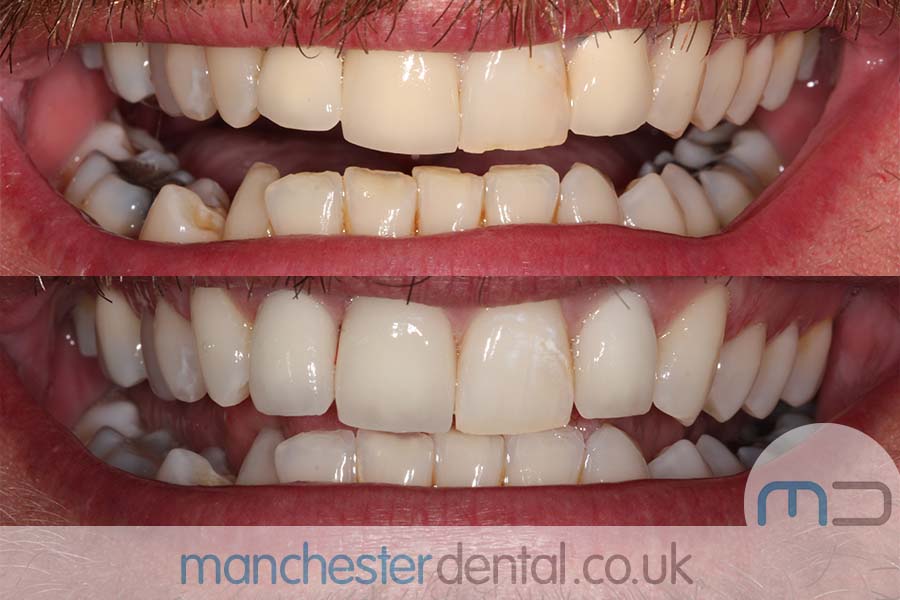 crowns and veneers in manchester