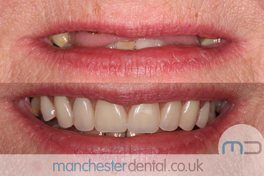 dentures in manchester