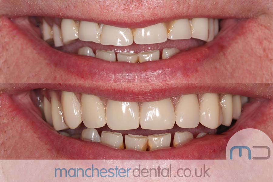 dentures in manchester