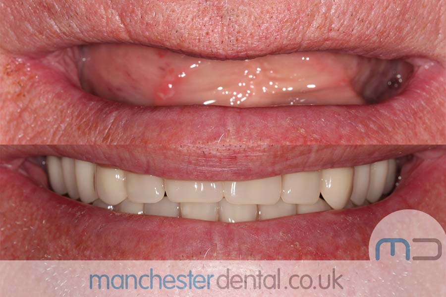 dentures in manchester