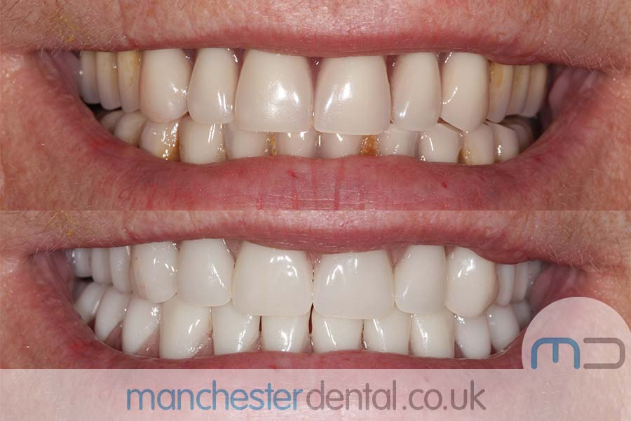 dentures in manchester