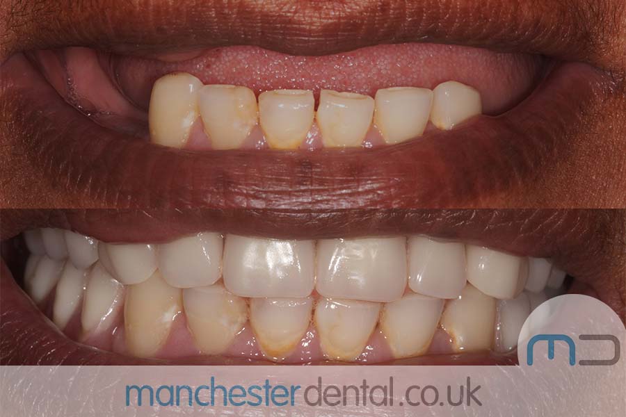 dentures in manchester