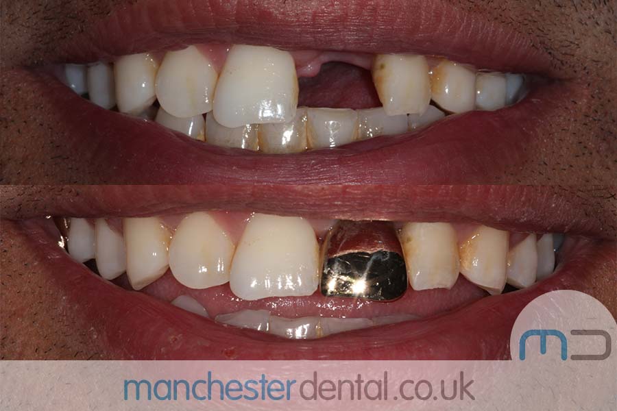 Gold Teeth Manchester