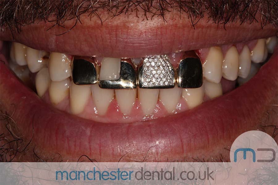 Gold Teeth Manchester