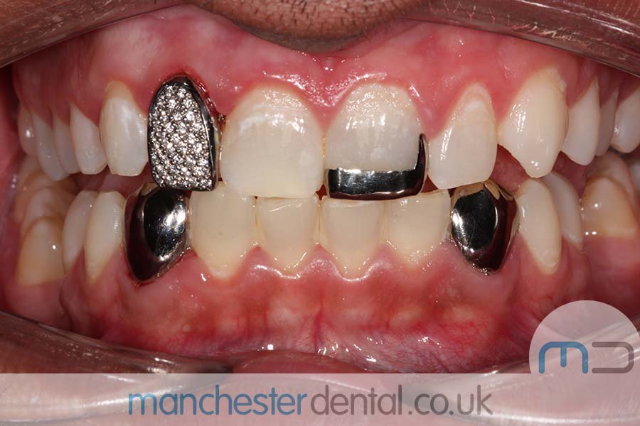 Gold Teeth Manchester