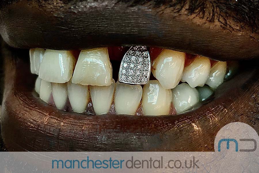 Gold Teeth Manchester