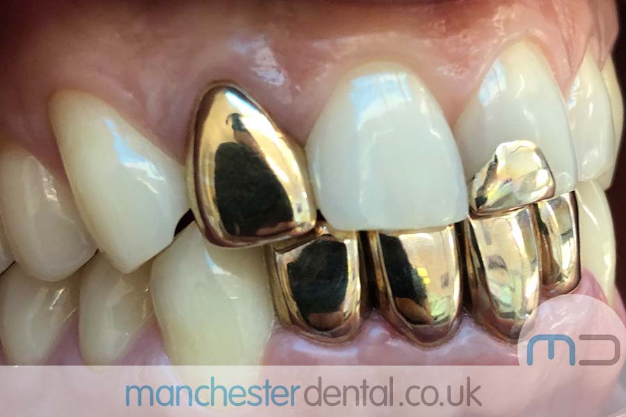 Gold Teeth Manchester