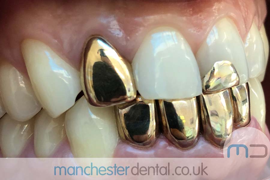 Gold Teeth / Gold Crowns Manchester Dental