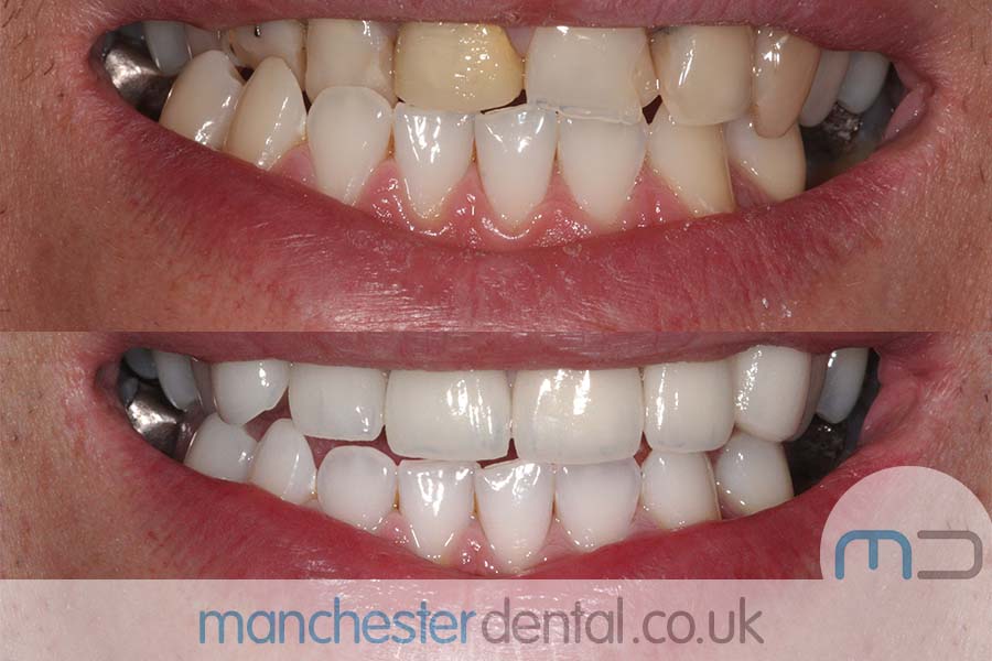 smile makeover manchester