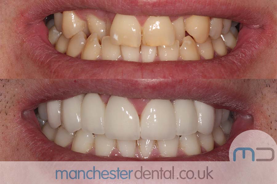 smile makeover manchester