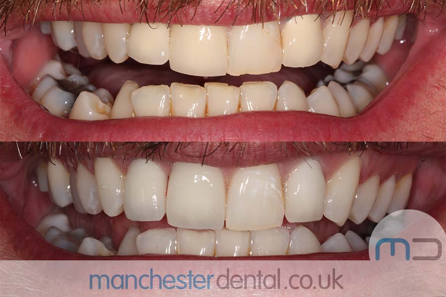 smile makeover manchester