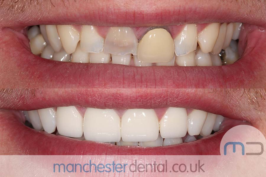 smile makeover manchester