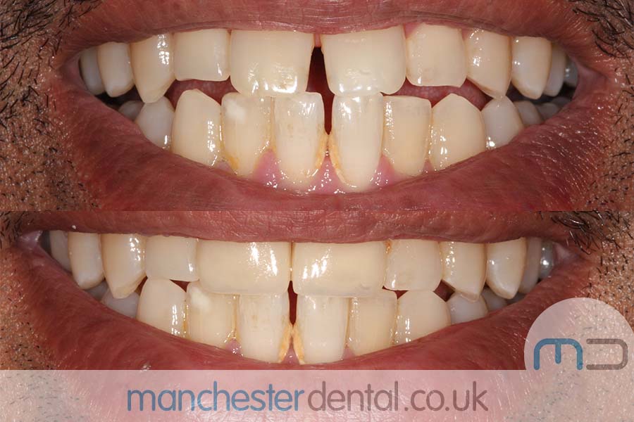 smile makeover manchester