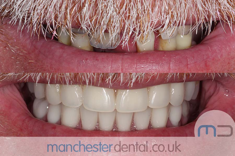 same day implants manchester