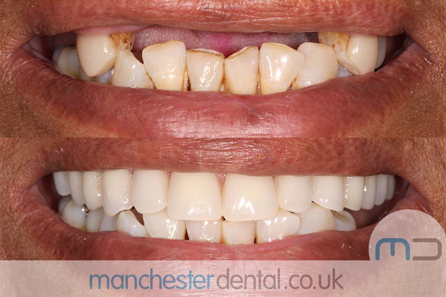 same day implants manchester