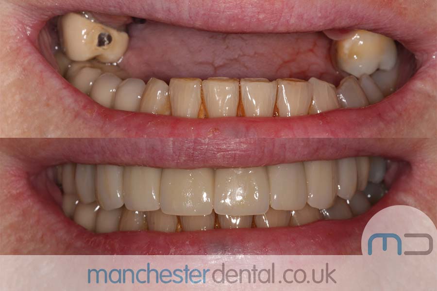 same day implants manchester