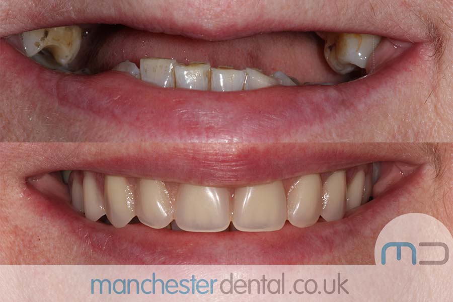 same day implants manchester