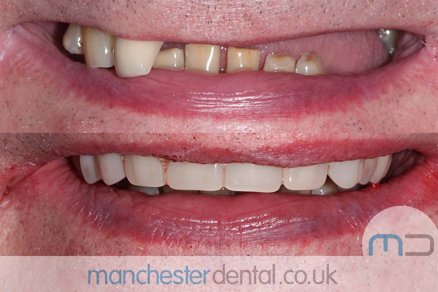 same day implants manchester