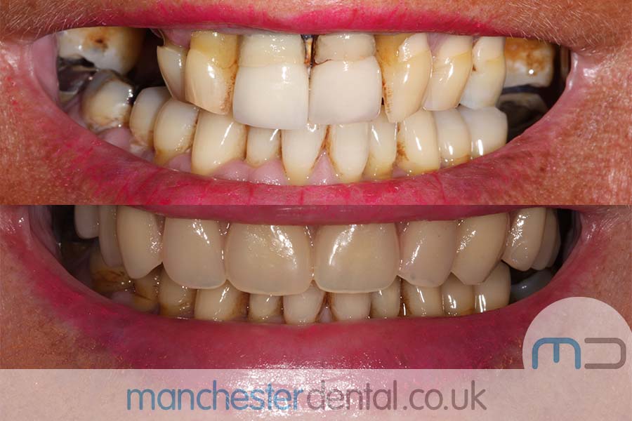 same day implants manchester