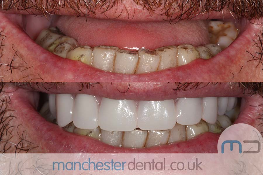 same day implants manchester