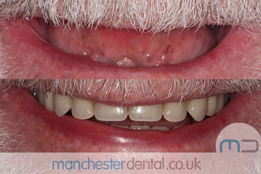 same day implants manchester