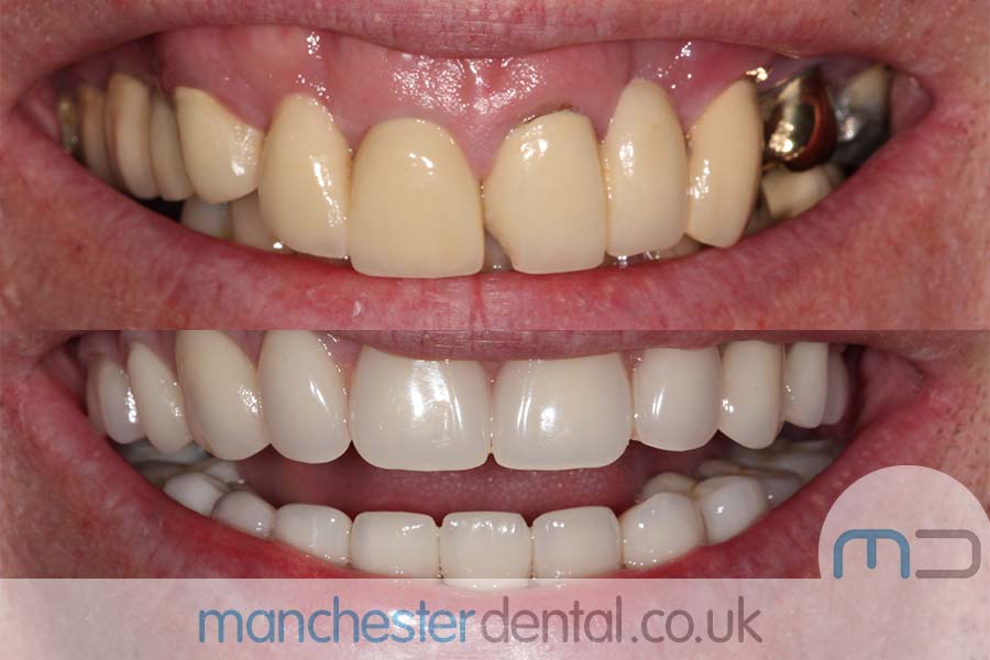 same day implants manchester