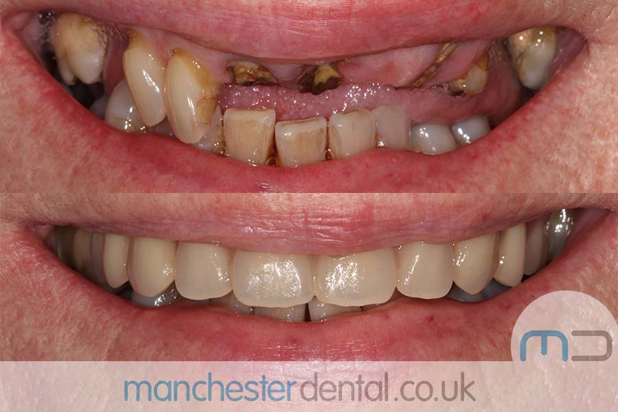 same day implants manchester