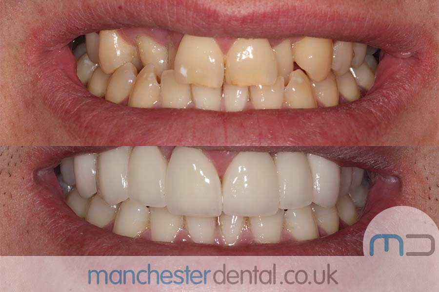 teeth whitening in manchester