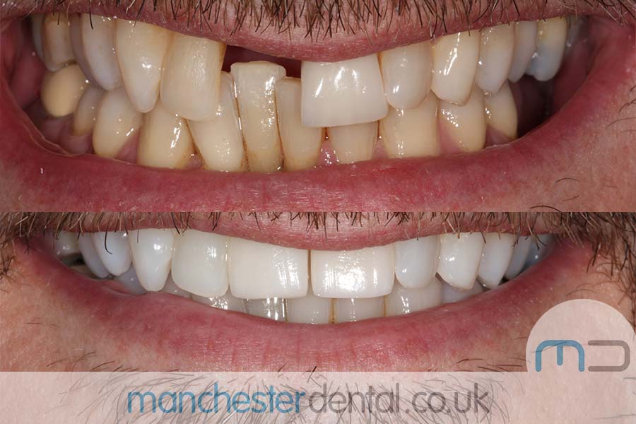 teeth whitening in manchester