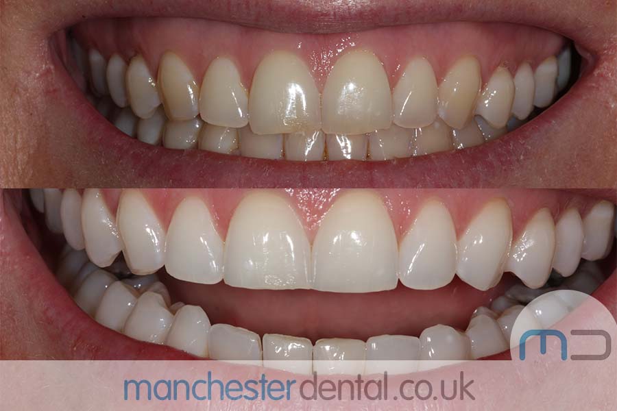 teeth whitening in manchester