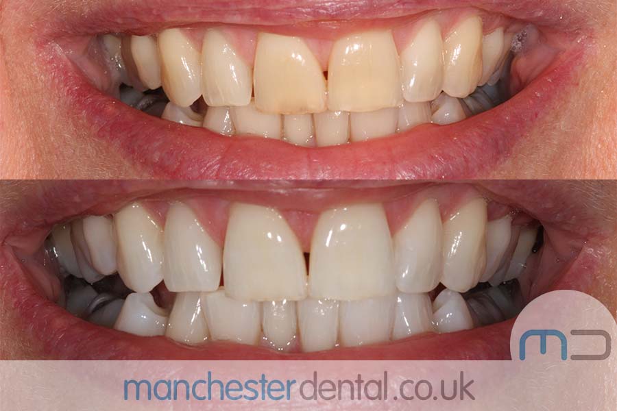 teeth whitening in manchester