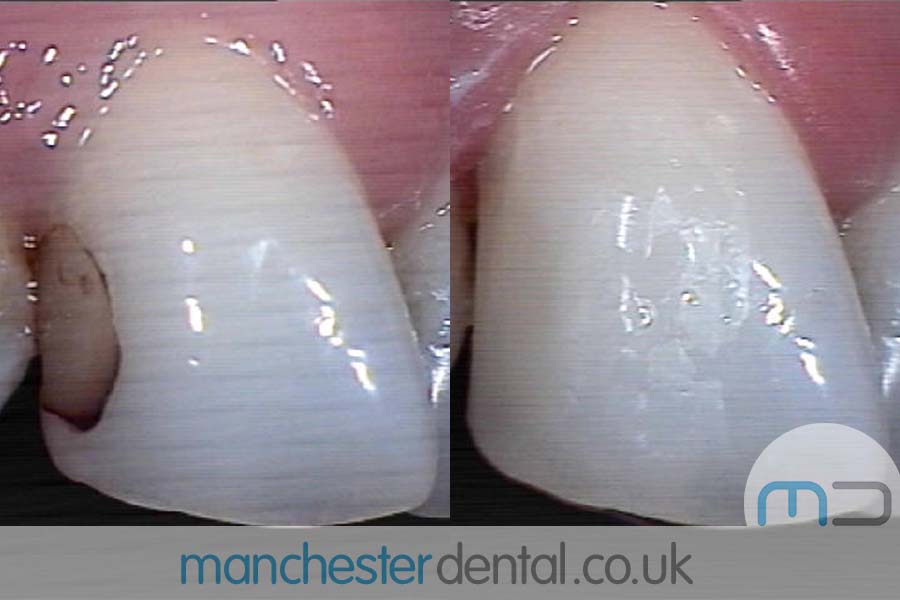 white fillings in manchester