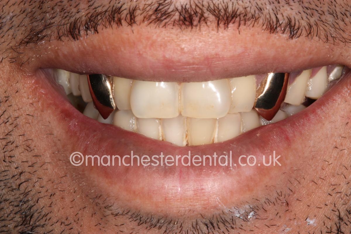 Gold Teeth / Gold Crowns Manchester Dental