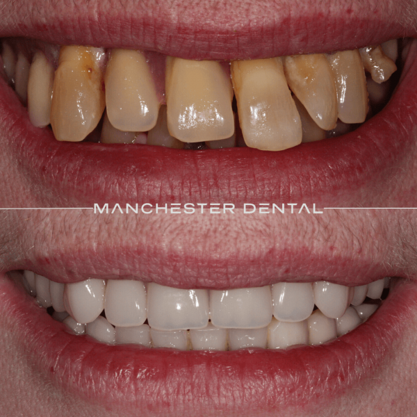 dental implants manchester