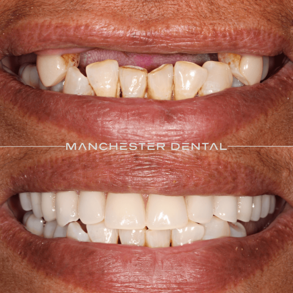 dental implants manchester