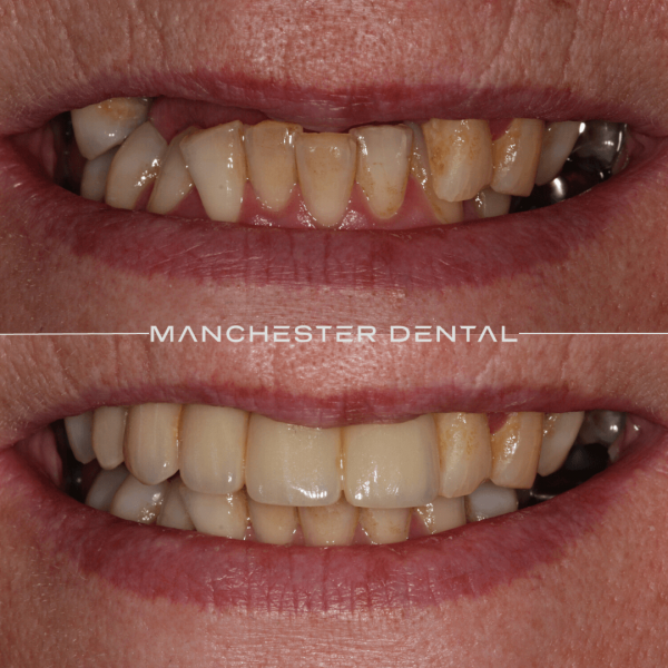 dental implants manchester