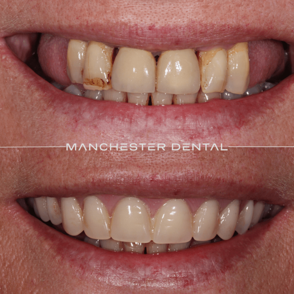 dental implants manchester