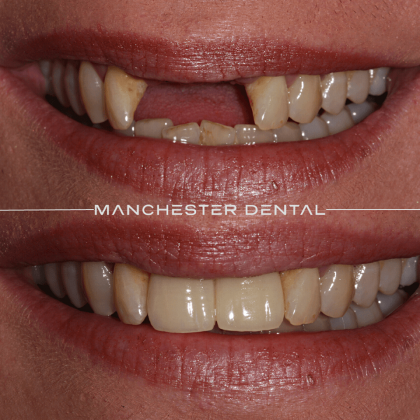 dental implants manchester