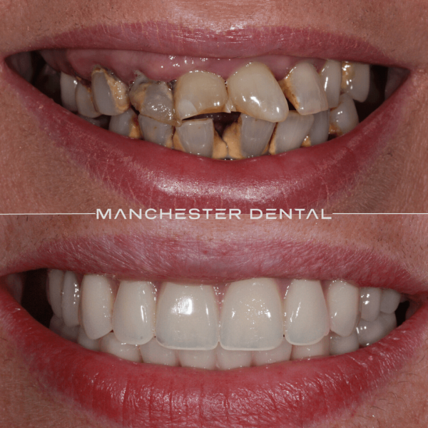 dental implants manchester