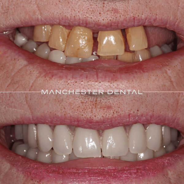 dental implants manchester