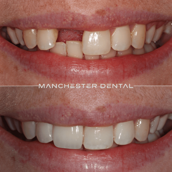 dental implants manchester