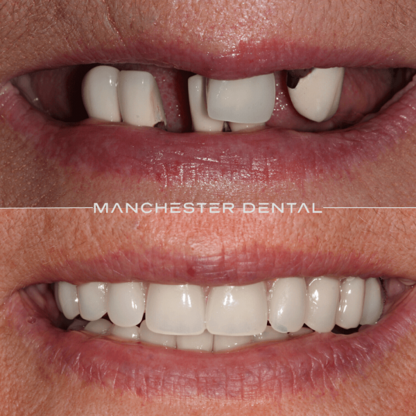 dental implants manchester