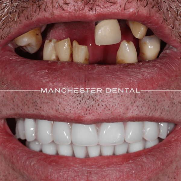 dental implants manchester