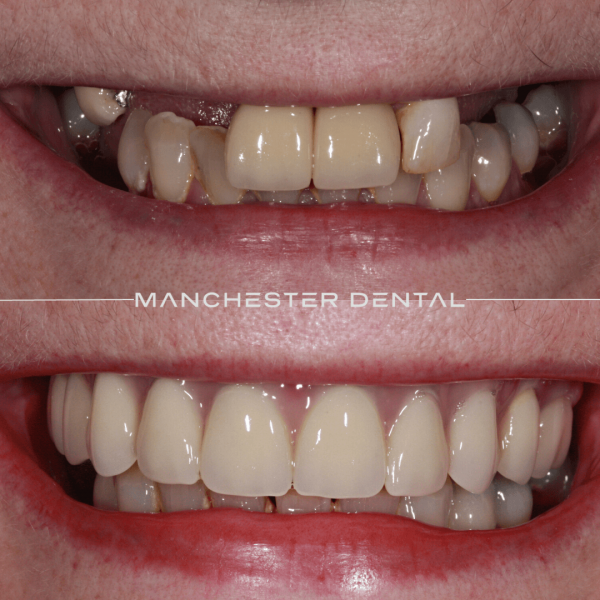 dental implants manchester