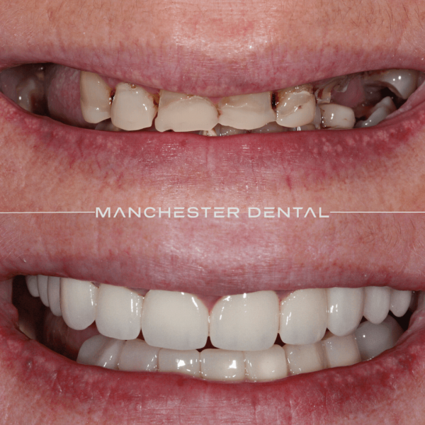 dental implants manchester